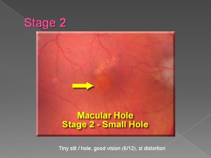 Stage 2 Tiny slit / hole, good vision (6/12), sl distortion 