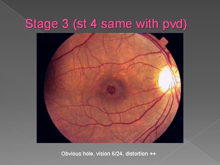 Stage 3 (st 4 same with pvd) Obvious hole, vision 6/24, distortion ++ 