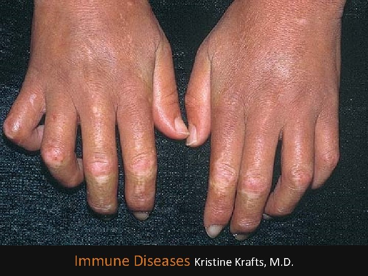 Immune Diseases Kristine Krafts, M. D. 