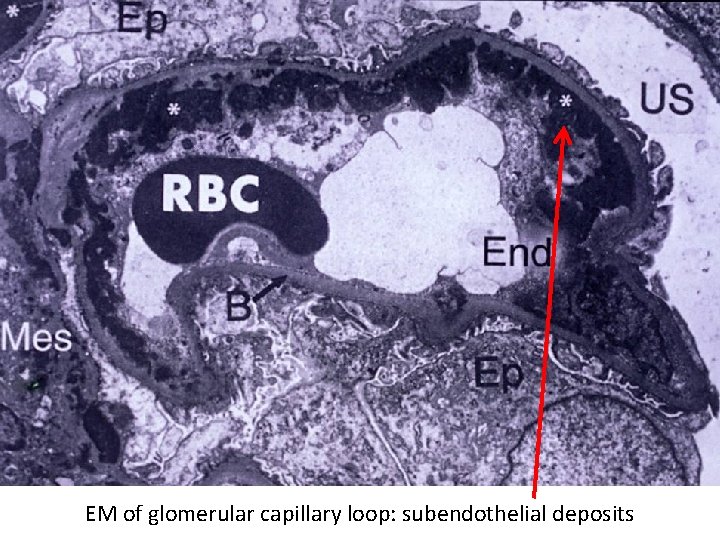 EM of glomerular capillary loop: subendothelial deposits 