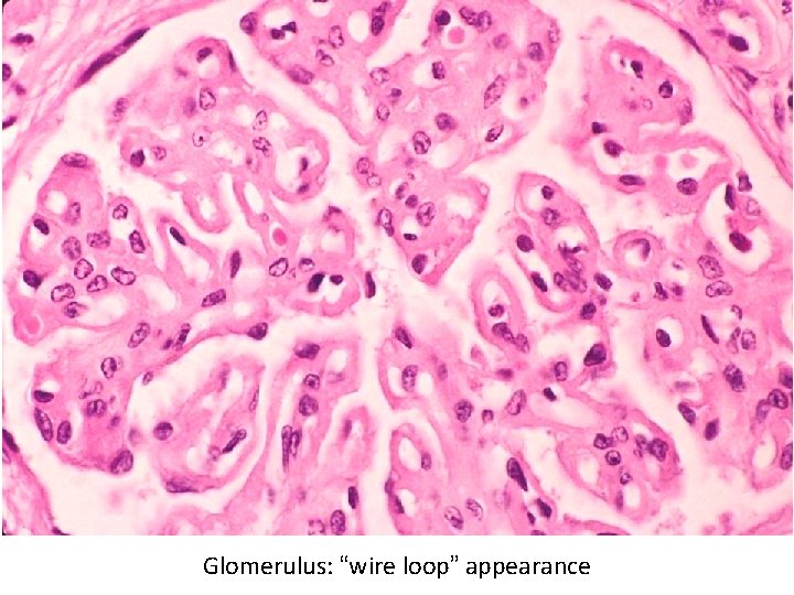 Glomerulus: “wire loop” appearance 