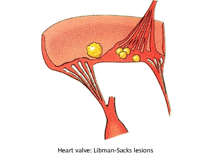 Heart valve: Libman-Sacks lesions 