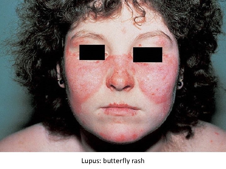 Lupus: butterfly rash 