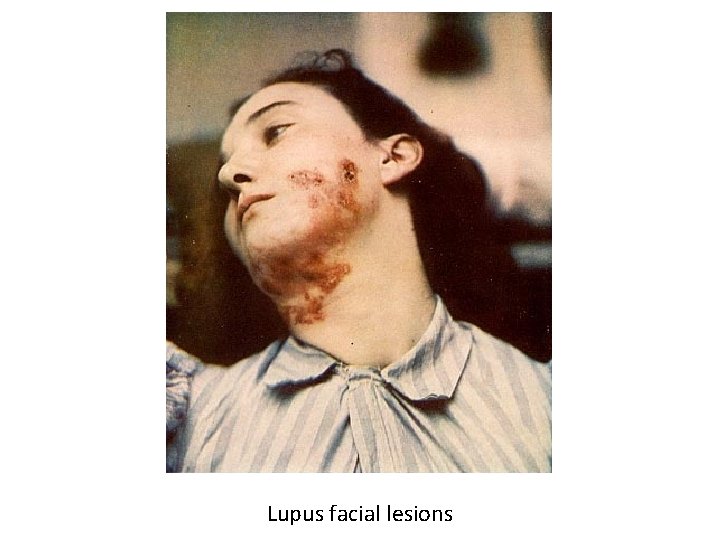 Lupus facial lesions 