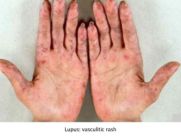 Lupus: vasculitic rash 