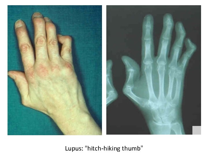 Lupus: “hitch-hiking thumb” 