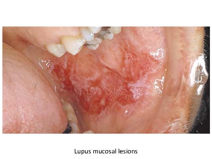 Lupus mucosal lesions 