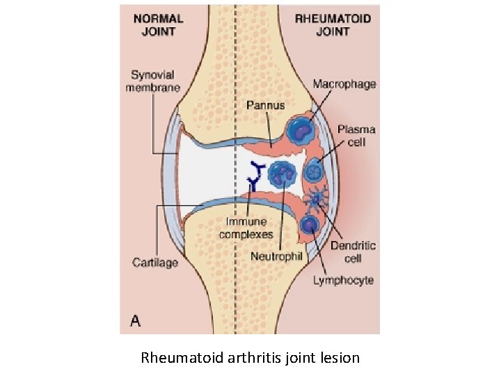Rheumatoid arthritis joint lesion 