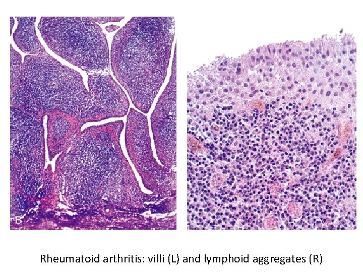 Rheumatoid arthritis: villi (L) and lymphoid aggregates (R) 