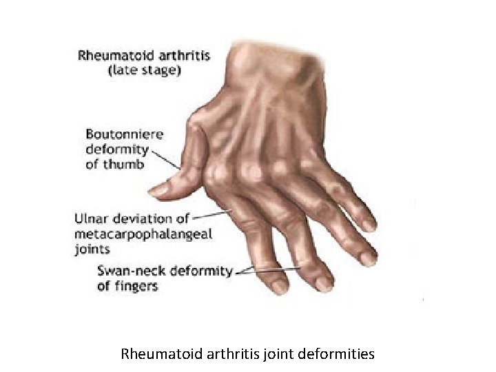 Rheumatoid arthritis joint deformities 