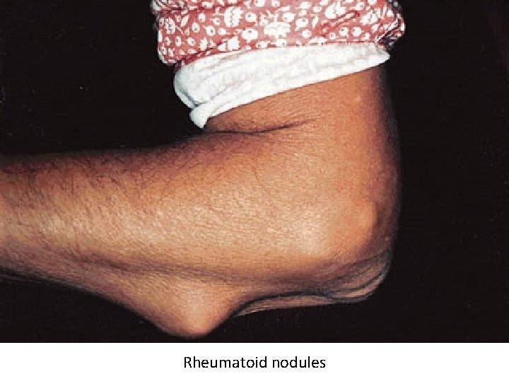 Rheumatoid nodules 