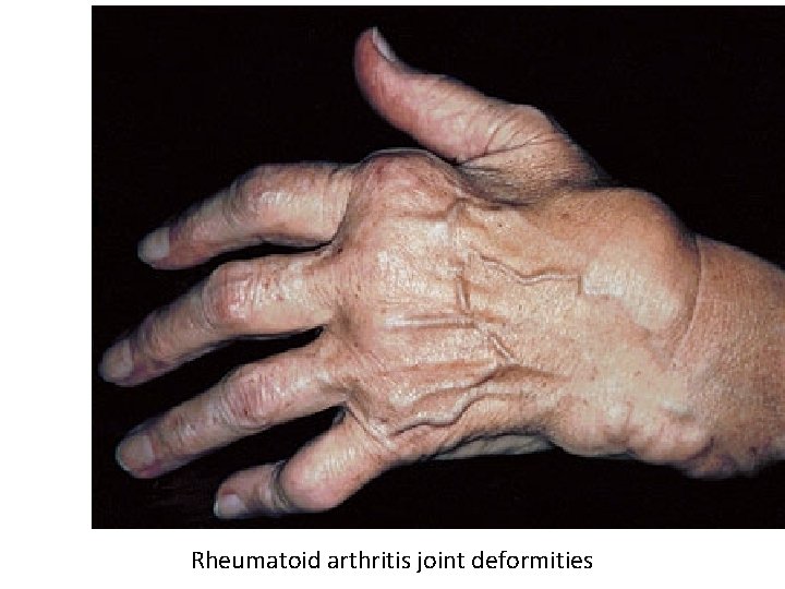 Rheumatoid arthritis joint deformities 