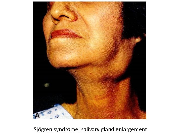 Sjögren syndrome: salivary gland enlargement 