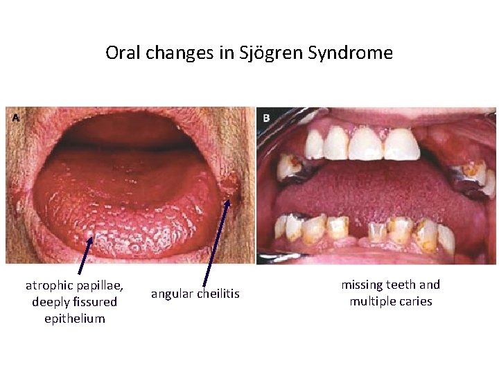 Oral changes in Sjögren Syndrome atrophic papillae, deeply fissured epithelium angular cheilitis missing teeth