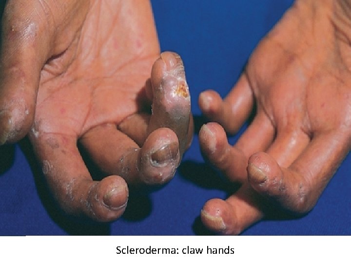 Scleroderma: claw hands 