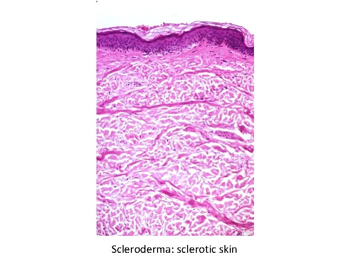 Scleroderma: sclerotic skin 