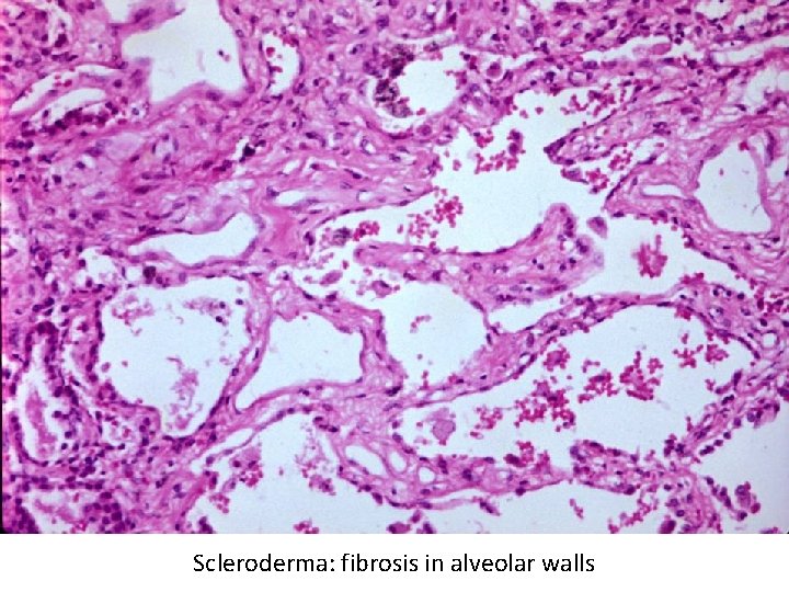 Scleroderma: fibrosis in alveolar walls 