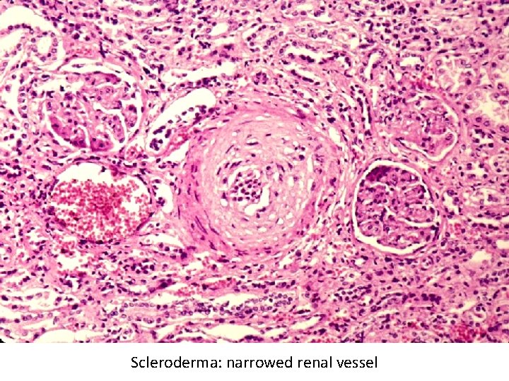 Scleroderma: narrowed renal vessel 