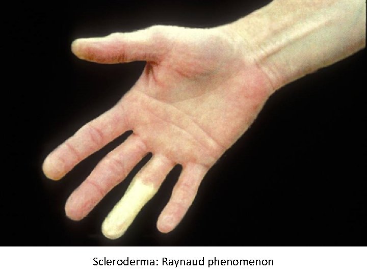 Scleroderma: Raynaud phenomenon 