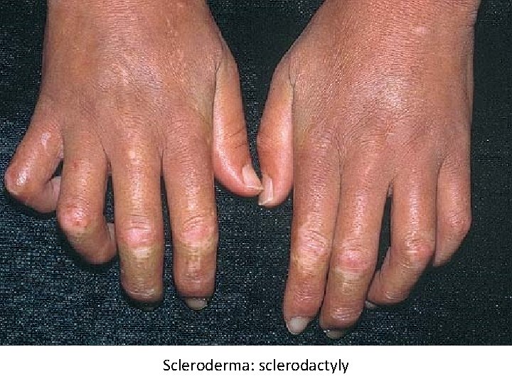 Scleroderma: sclerodactyly 