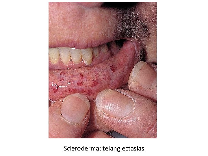 Scleroderma: telangiectasias 