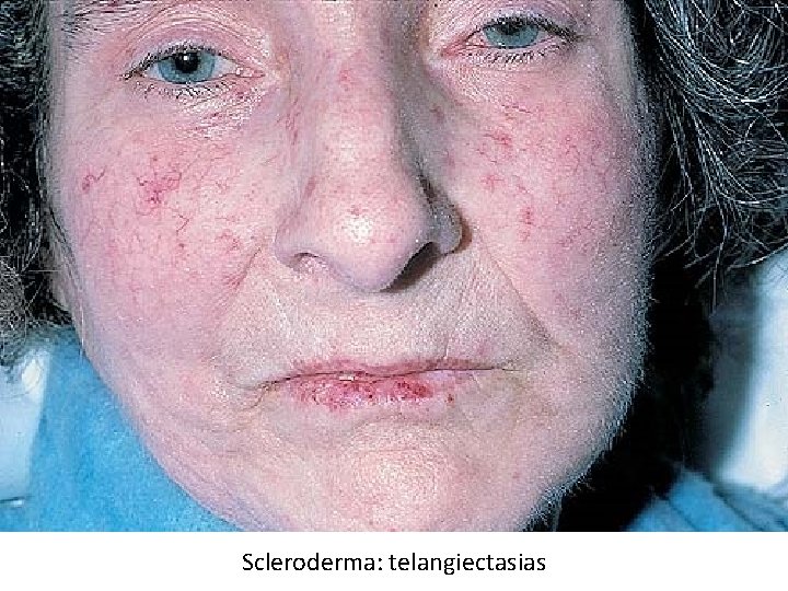 Scleroderma: telangiectasias 