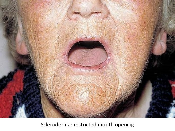 Scleroderma: restricted mouth opening 