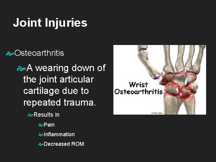 Joint Injuries Osteoarthritis A wearing down of the joint articular cartilage due to repeated