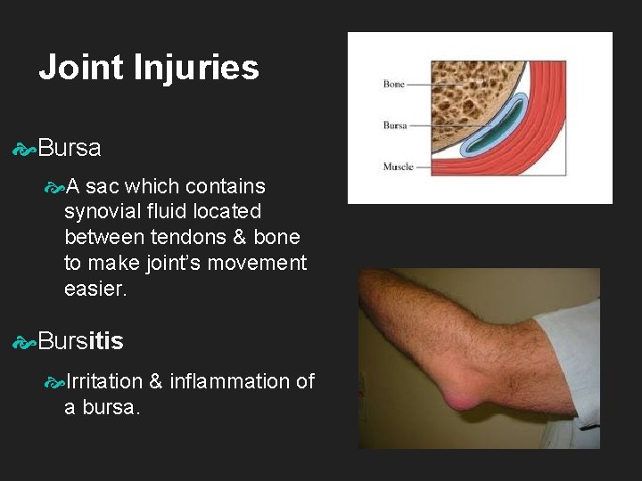 Joint Injuries Bursa A sac which contains synovial fluid located between tendons & bone