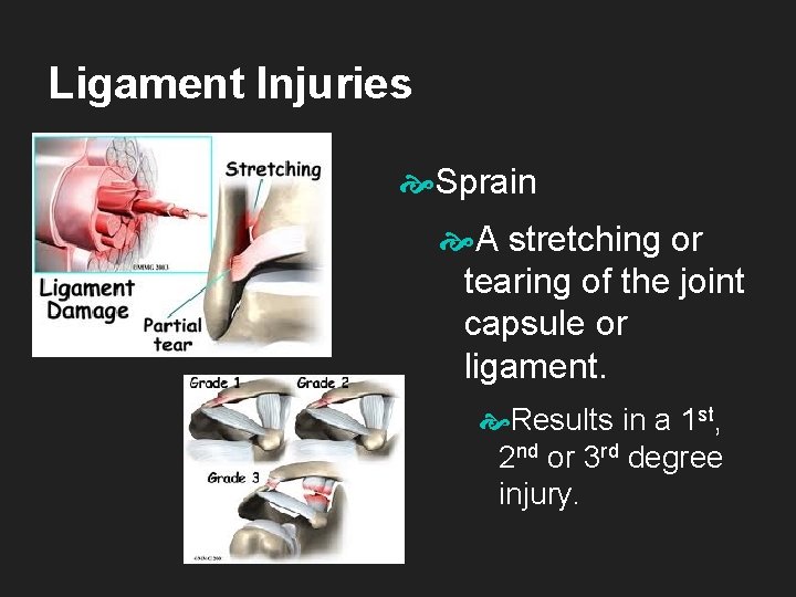 Ligament Injuries Sprain A stretching or tearing of the joint capsule or ligament. Results