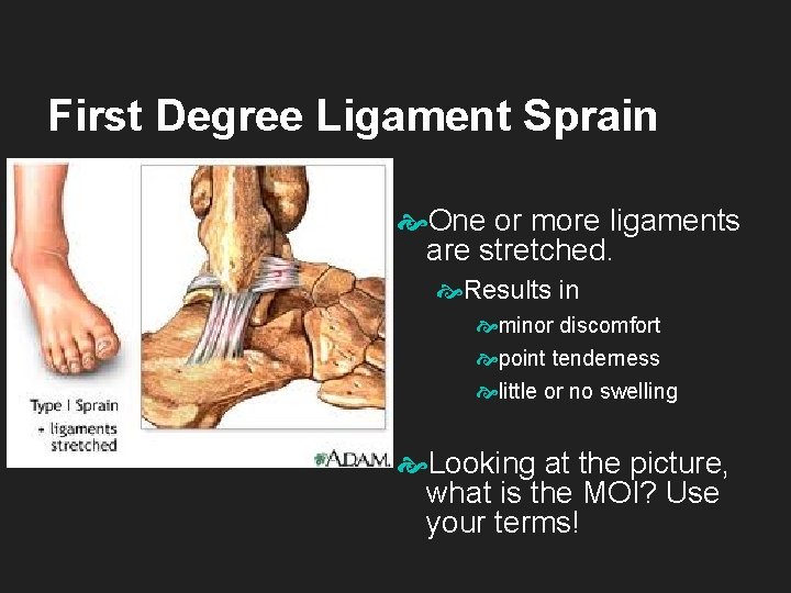 First Degree Ligament Sprain One or more ligaments are stretched. Results in minor discomfort