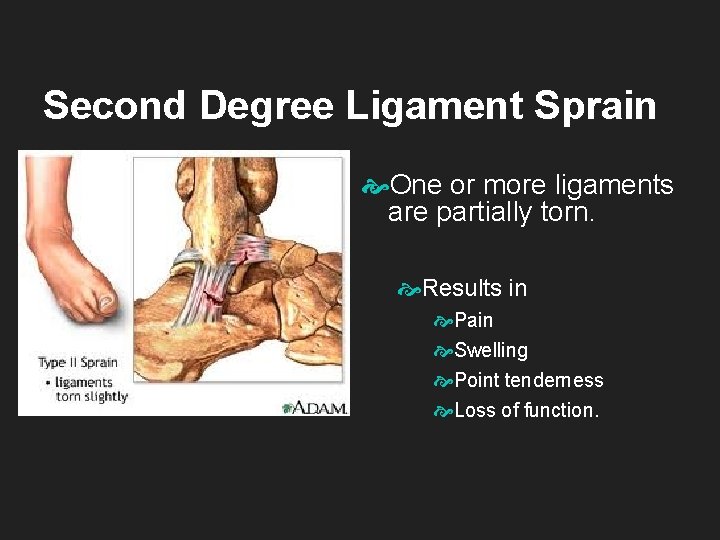 Second Degree Ligament Sprain One or more ligaments are partially torn. Results in Pain