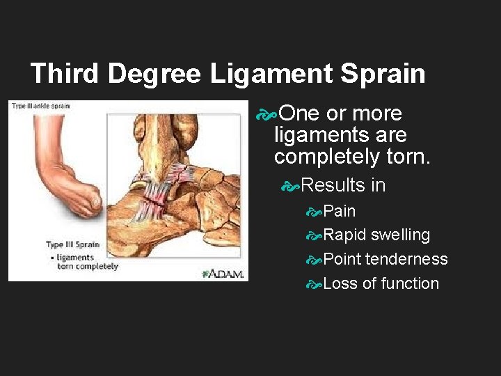 Third Degree Ligament Sprain One or more ligaments are completely torn. Results in Pain