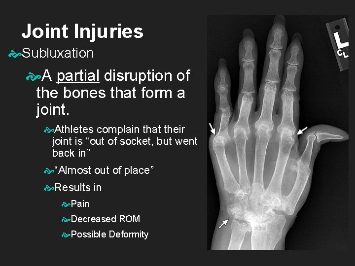 Joint Injuries Subluxation A partial disruption of the bones that form a joint. Athletes