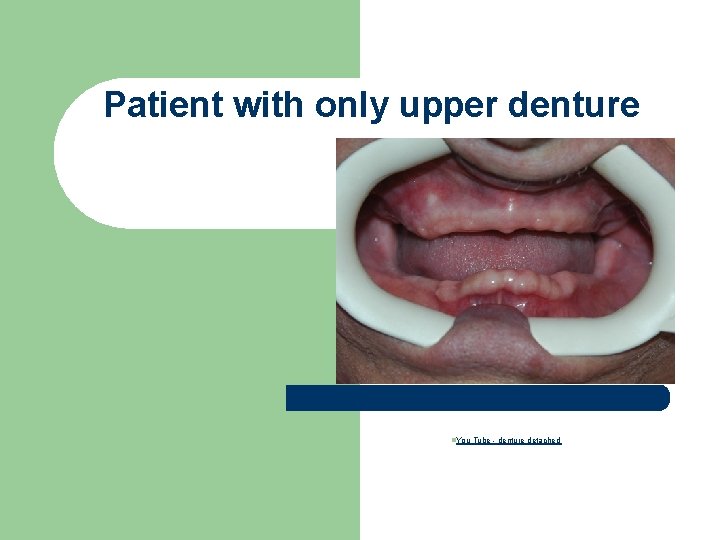 Patient with only upper denture n. You Tube - denture detached 