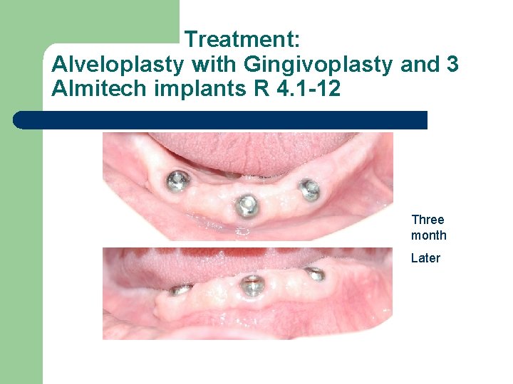 Treatment: Alveloplasty with Gingivoplasty and 3 Almitech implants R 4. 1 -12 Three month