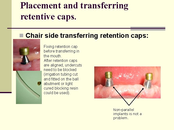 Placement and transferring retentive caps. n Chair side transferring retention caps: Fixing retention cap