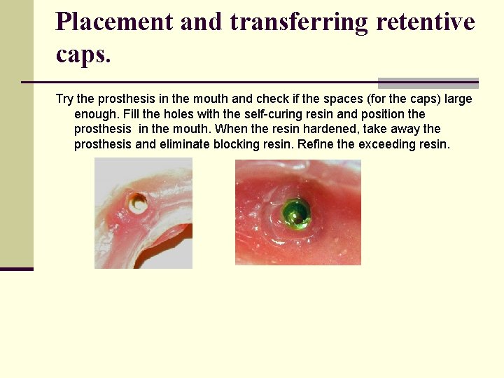 Placement and transferring retentive caps. Try the prosthesis in the mouth and check if