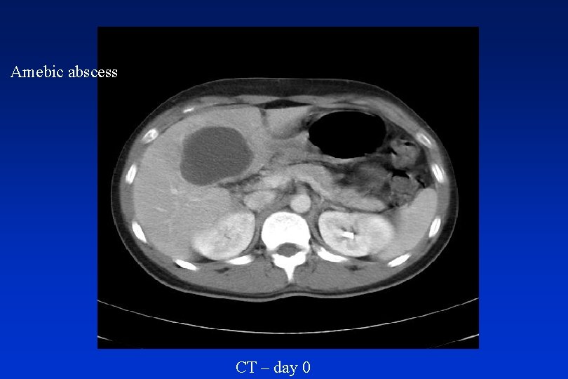 Amebic abscess CT – day 0 