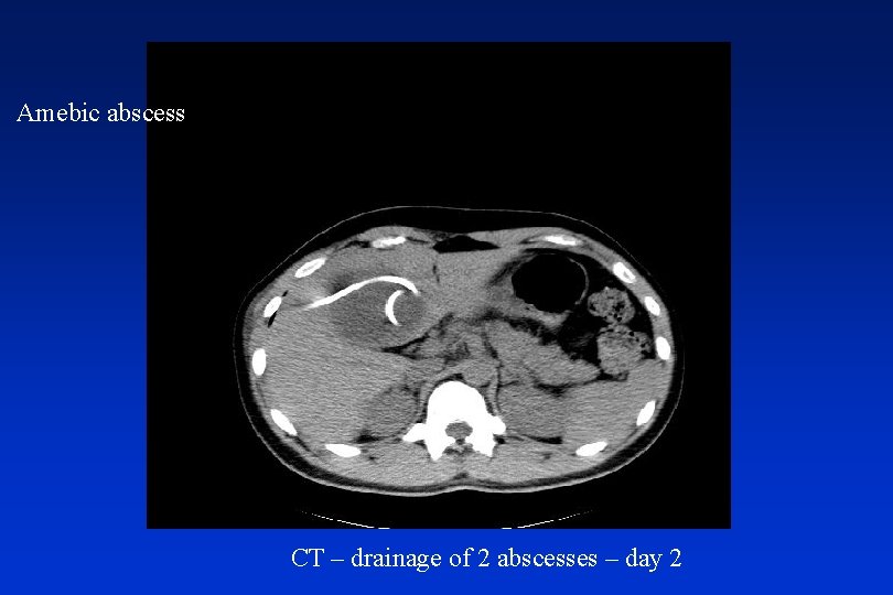 Amebic abscess CT – drainage of 2 abscesses – day 2 