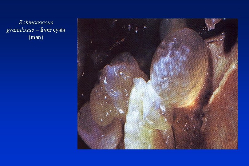 Echinococcus granulosus – liver cysts (man) 