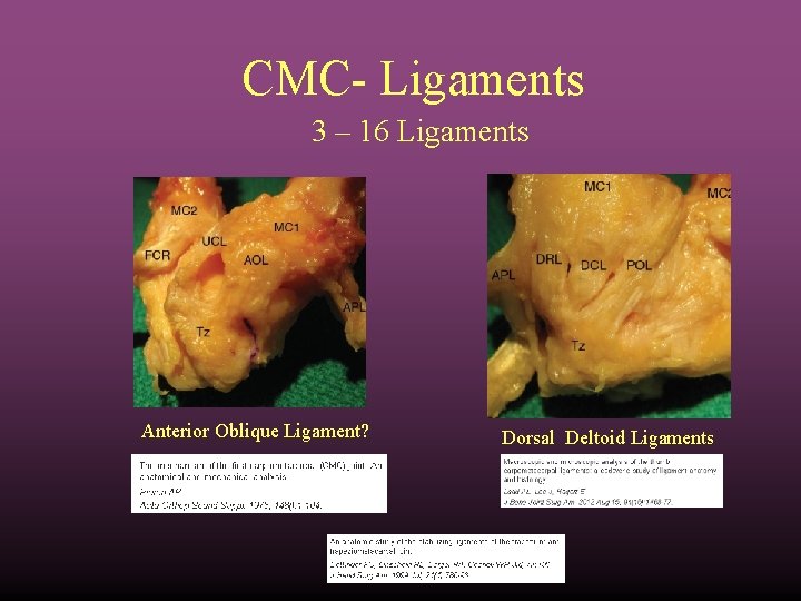 CMC- Ligaments 3 – 16 Ligaments Anterior Oblique Ligament? Dorsal Deltoid Ligaments 