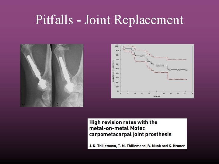 Pitfalls - Joint Replacement 