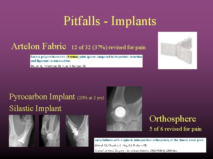 Pitfalls - Implants Artelon Fabric 12 of 32 (37%) revised for pain Pyrocarbon Implant