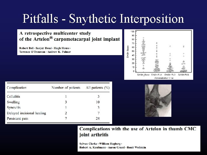 Pitfalls - Snythetic Interposition 