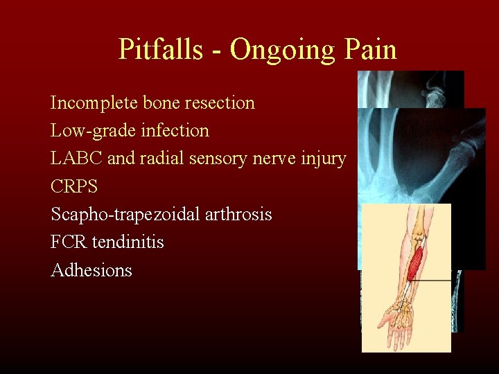 Pitfalls - Ongoing Pain Incomplete bone resection Low-grade infection LABC and radial sensory nerve