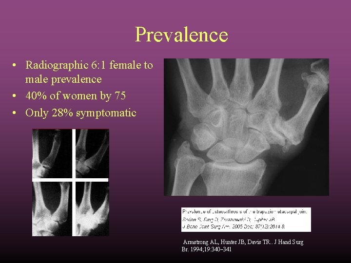 Prevalence • Radiographic 6: 1 female to male prevalence • 40% of women by