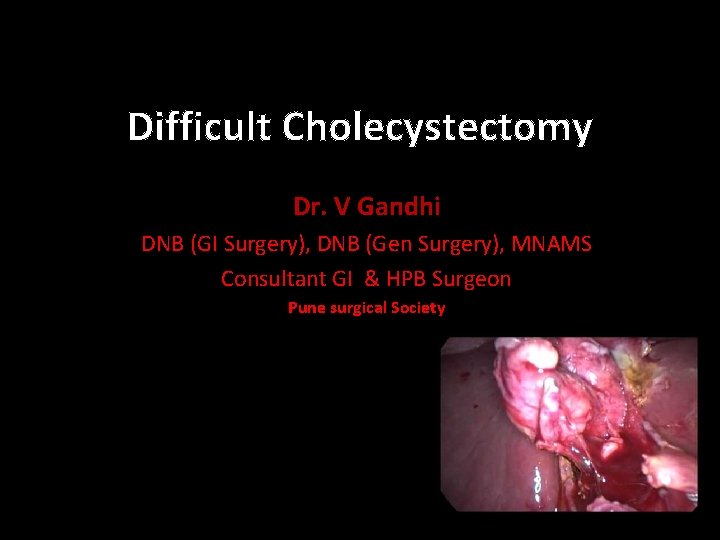 Difficult Cholecystectomy Dr. V Gandhi DNB (GI Surgery), DNB (Gen Surgery), MNAMS Consultant GI