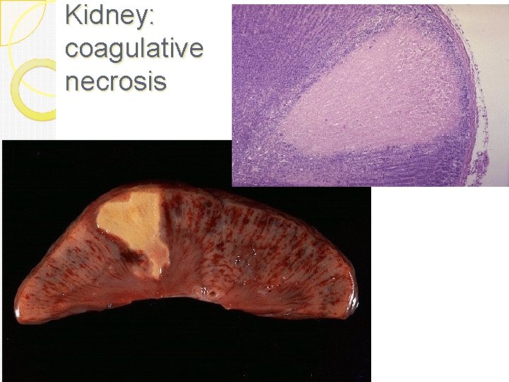 Kidney: coagulative necrosis 