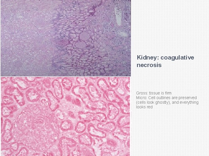 Kidney: coagulative necrosis Gross: tissue is firm Micro: Cell outlines are preserved (cells look